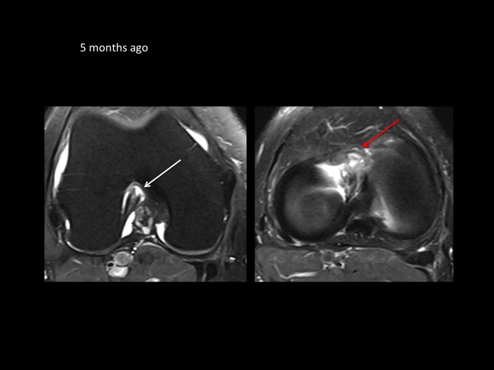 Figure 6 for case anterior cruciate ligament ( RID2781 )